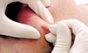 bisul_skin_swelling_boil